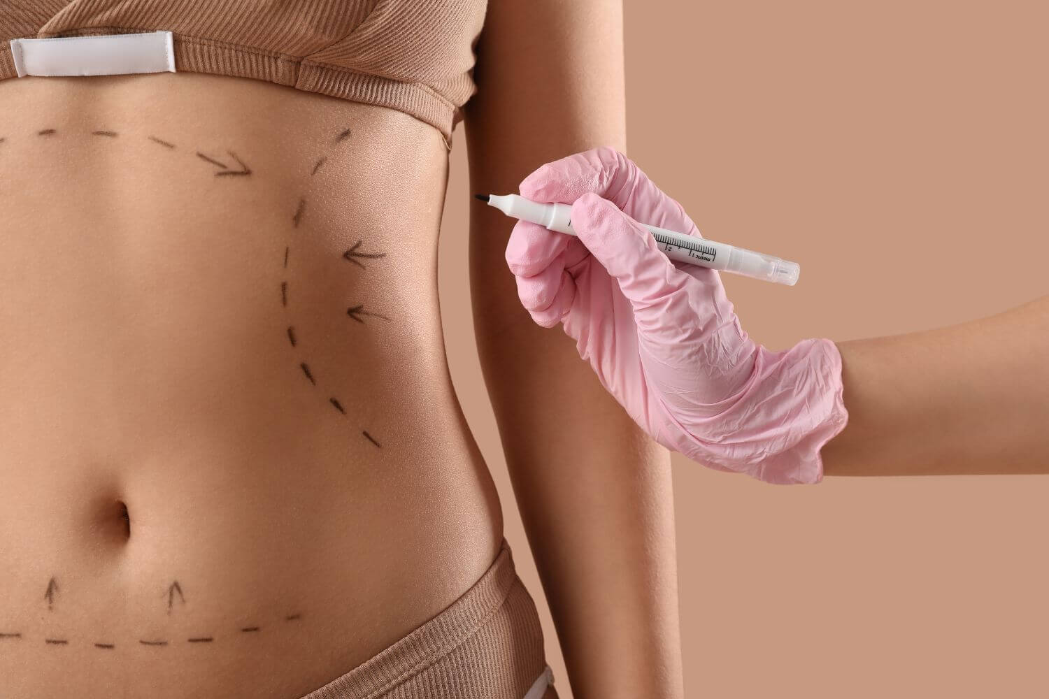 Abdominoplastia